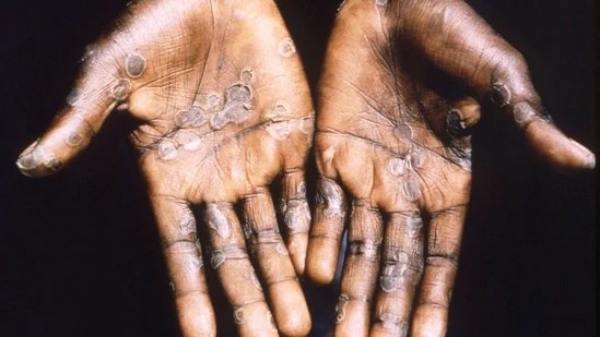monkey pox